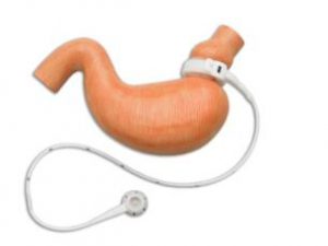 Laparoscopic Adjustable Gastric Band